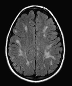 brain mri